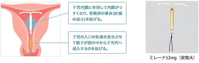 ミレーナ52mgの写真 子宮内膜に作用して内膜がうすくなり、受精卵の着床（妊娠の成立）を妨げる。支給の入り口の粘液を変化させて精子が腟の中から子宮内へ侵入するのを妨げる。